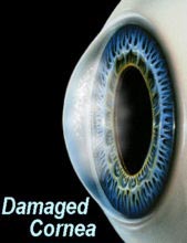 corneal transplant 2_1.jpg